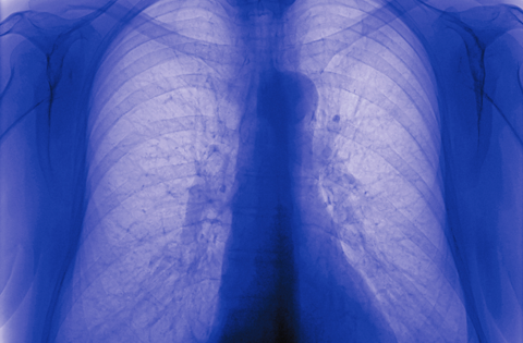 Blue-tinted chest X-ray showing the lungs, illustrating the respiratory effects of silicosis