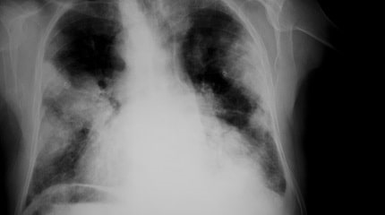 Lung Cancer X Ray Istock SMLL