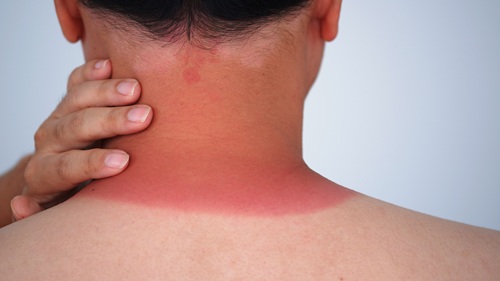 Sunburn Istock 1643317781 Wisely